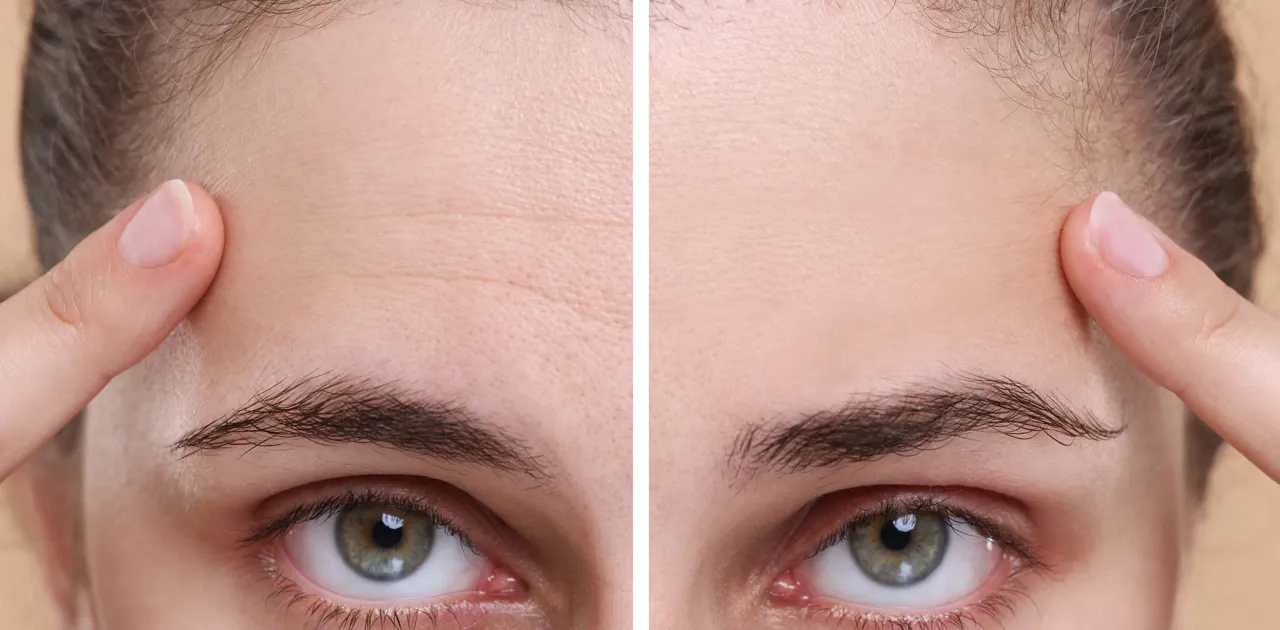 wrinkle prevention